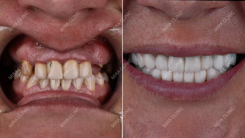 Before, Treatment Plan, and Final Result